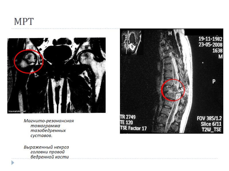 МРТ Магнито-резонансная томограмма тазобедренных суставов.   Выраженный некроз головки правой бедренной кости